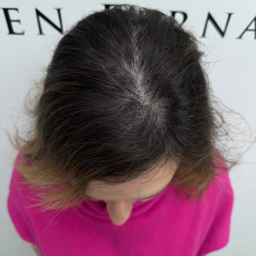 Densidad capilar en mujer